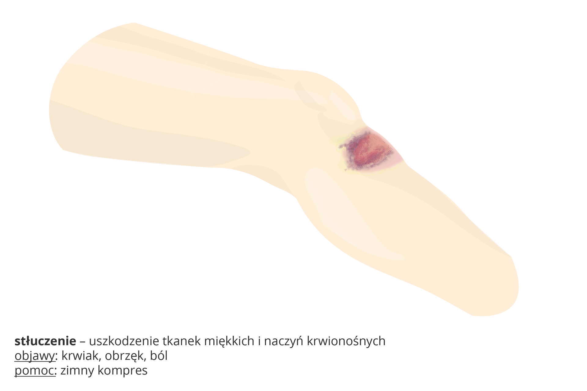 Ilustracja przedstawia schematycznie różowy fragment nogi z czerwono – fioletową plamą pod kolanem. To stłuczenie, czyli uszkodzenie tkanek miękkich i naczyń krwionośnych. Objawy: krwiak, obrzęk, ból. Pomoc: zimny kompres.