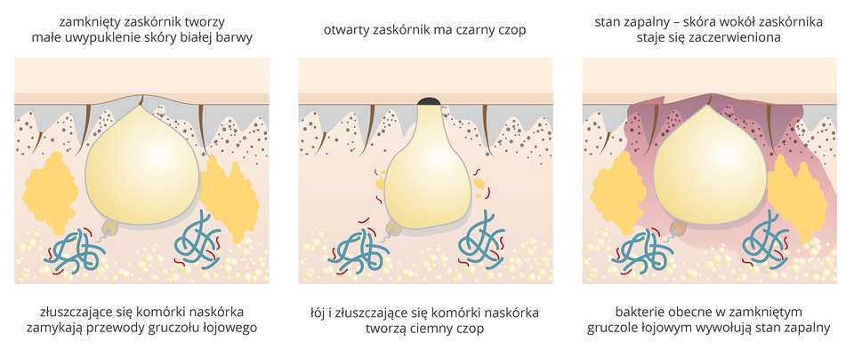 Ilustracja składa się z 3 części. Na pierwszej widziany w przekroju skóry zamknięty zaskórnik, który tworzy na powierzchni skóry białawe uwypuklenie.Na drugiej ilustracji zaskórnik - zamkniety czarnym czopem. Na trzeciej - stan zapalny zaskórnika, wokół niego nabrzmiałe tkanki.