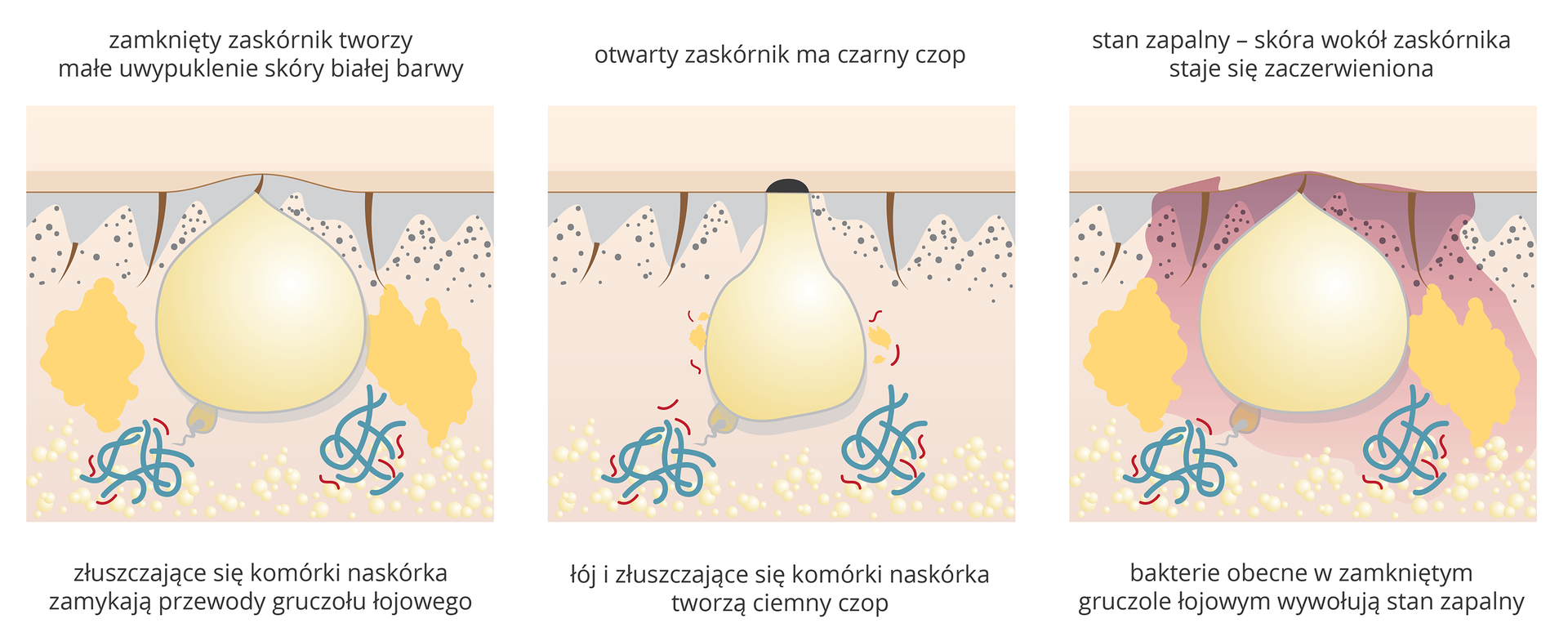 Ilustracja składa się z 3 części. Na pierwszej widziany w przekroju skóry zamknięty zaskórnik, który tworzy na powierzchni skóry białawe uwypuklenie.Na drugiej ilustracji zaskórnik - zamkniety czarnym czopem. Na trzeciej - stan zapalny zaskórnika, wokół niego nabrzmiałe tkanki.