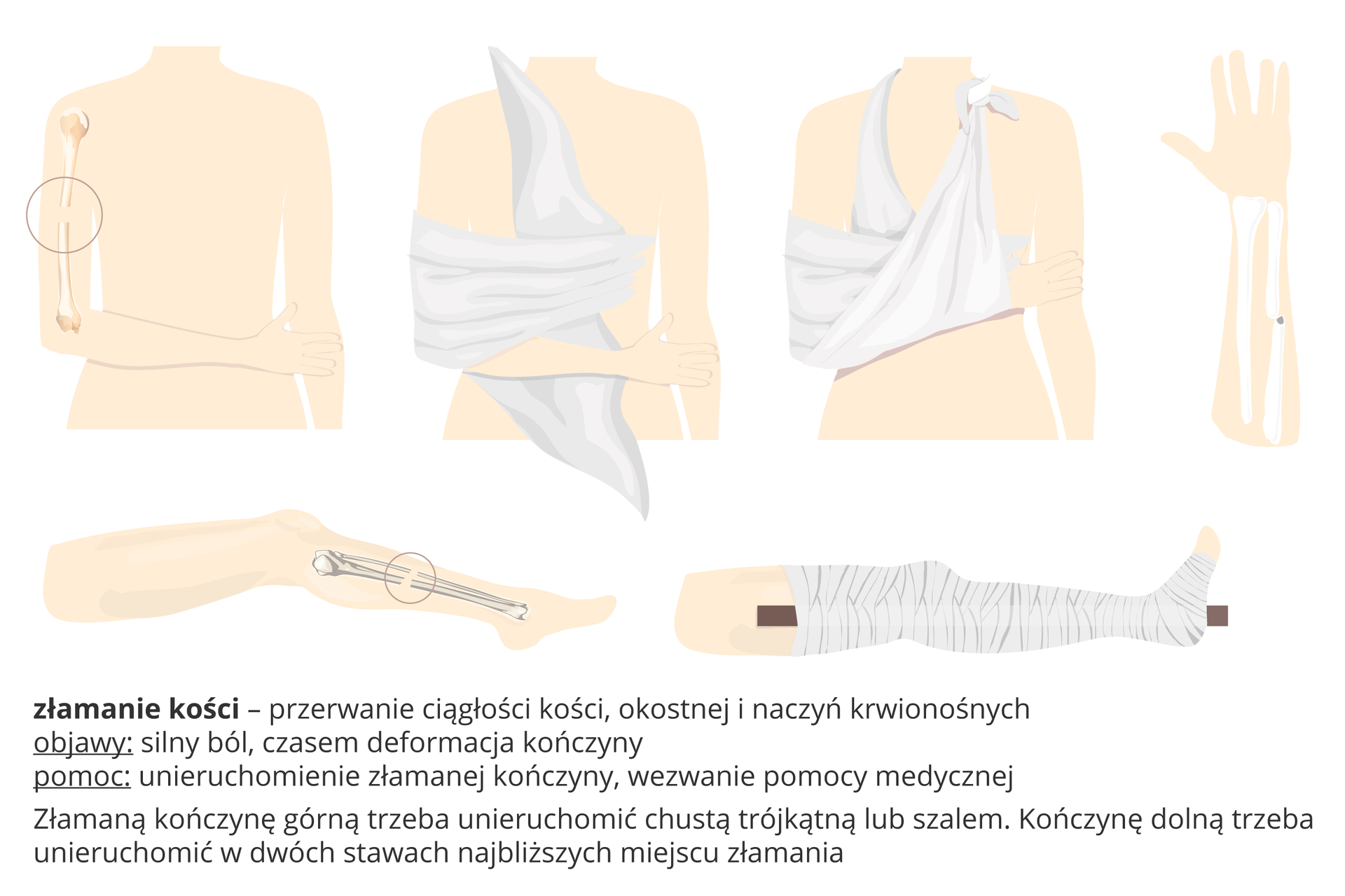 Ilustracja przedstawia różowe torsy i kończyny z wrysowanymi kośćmi, które uległy złamaniu. Z lewej u góry: przerwanie ciągłości kości ramiennej. Pierwsza pomoc: unieruchomienie ręki. Kolejne obrazki ilustrują sposób zawiązania chusty: owinięcie na ręce i zawiązanie na karku. Z prawej złamanie kości łokciowej. Taka sama pierwsza pomoc. U dołu: złamanie obu kości podudzia. Pierwsza pomoc: usztywnienie sąsiednich stawów i zawinięcie kończyny. Objawy złamania: silny ból, czasem deformacja kończyny. Pomoc: unieruchomienie kończyny, wezwanie pomocy medycznej.