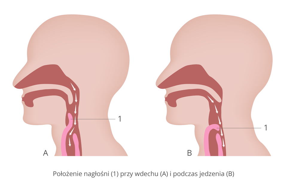 Ilustracja przedstawia z profilu dwie sylwetki głowy człowieka. Wrysowano ciemnoróżowe drogi oddechowe z jasnoróżową nagłośnią, opisaną cyfrą jeden. Po lewej sytuacja przy wdechu: nagłośnia uniesiona do góry, powietrze (strzałki) wchodzi do dróg oddechowych. Z prawej sytuacja przy przełykaniu: nagłośnia opuszczona, drogi oddechowe zamknięte. Pokarm przechodzi do przełyku.