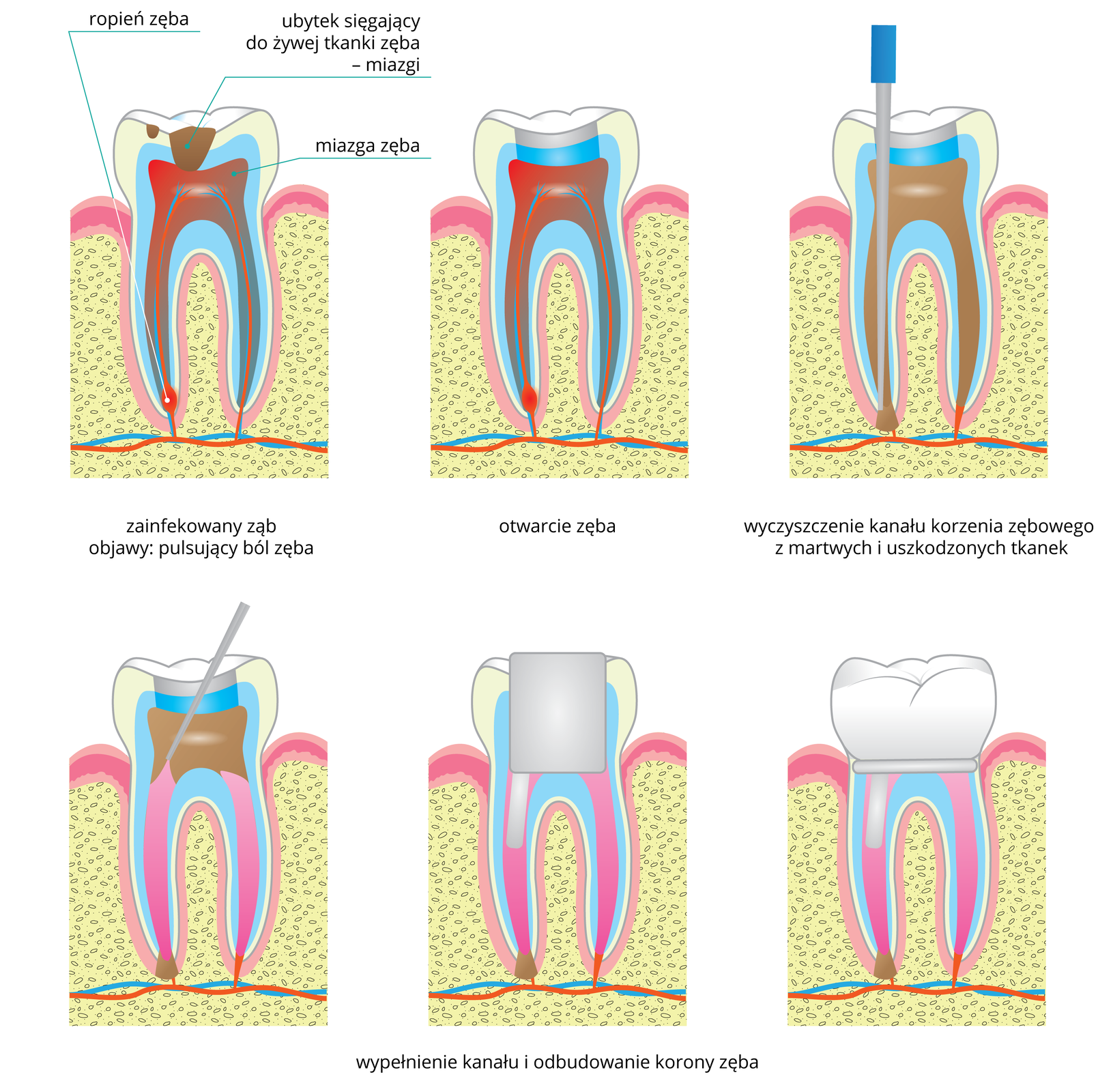 Na ilustracji znajduje się w dwóch rzędach 6 rysunków zęba, przedstawiających kolejne etapy leczenia ropnia. W lewym górnym rogu ukazano zainfekowany ząb. Na szkliwie są brązowe plamki, czyli ubytki. Jeden z nich sięga do żywej tkanki zęba – miazgi. Na czerwono zaznaczono bolesny stan zapalny miazgi, a w lewym korzeniu zęba ropień. Środkowy rysunek przedstawia otwarcie zęba: w koronie zęba dentysta usunął część szkliwa z ubytkami. Następnie do korzenia zęba z ropniem wprowadził szaro – niebieskie narzędzie, którym usunął martwe tkanki. W dolnym rzędzie z lewej przedstawiono na różowo wypełnienie kanału zęba, w następnym szarym czworokątem oznaczono odbudowanie korony zęba. Ostatni rysunek przedstawia wyleczony ząb.