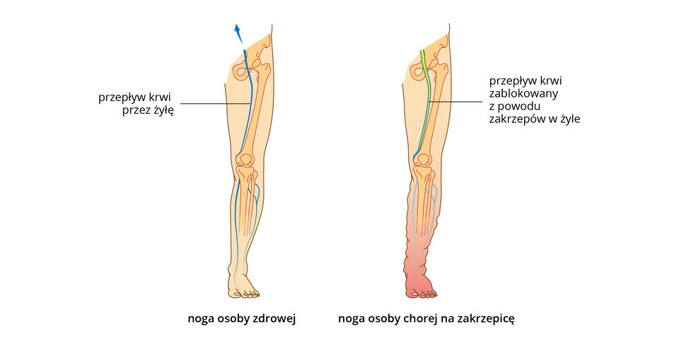 Ilustracja przedstawia różowe sylwetki nóg człowieka, z wrysowanymi kośćmi i żyłami. Noga po lewej jest zdrowa. W nodze po prawej u góry żółtym kolorem ukazano zakrzepy, blokujące żyłę. Noga na dole jest zaczerwieniona i obrzęknięta.