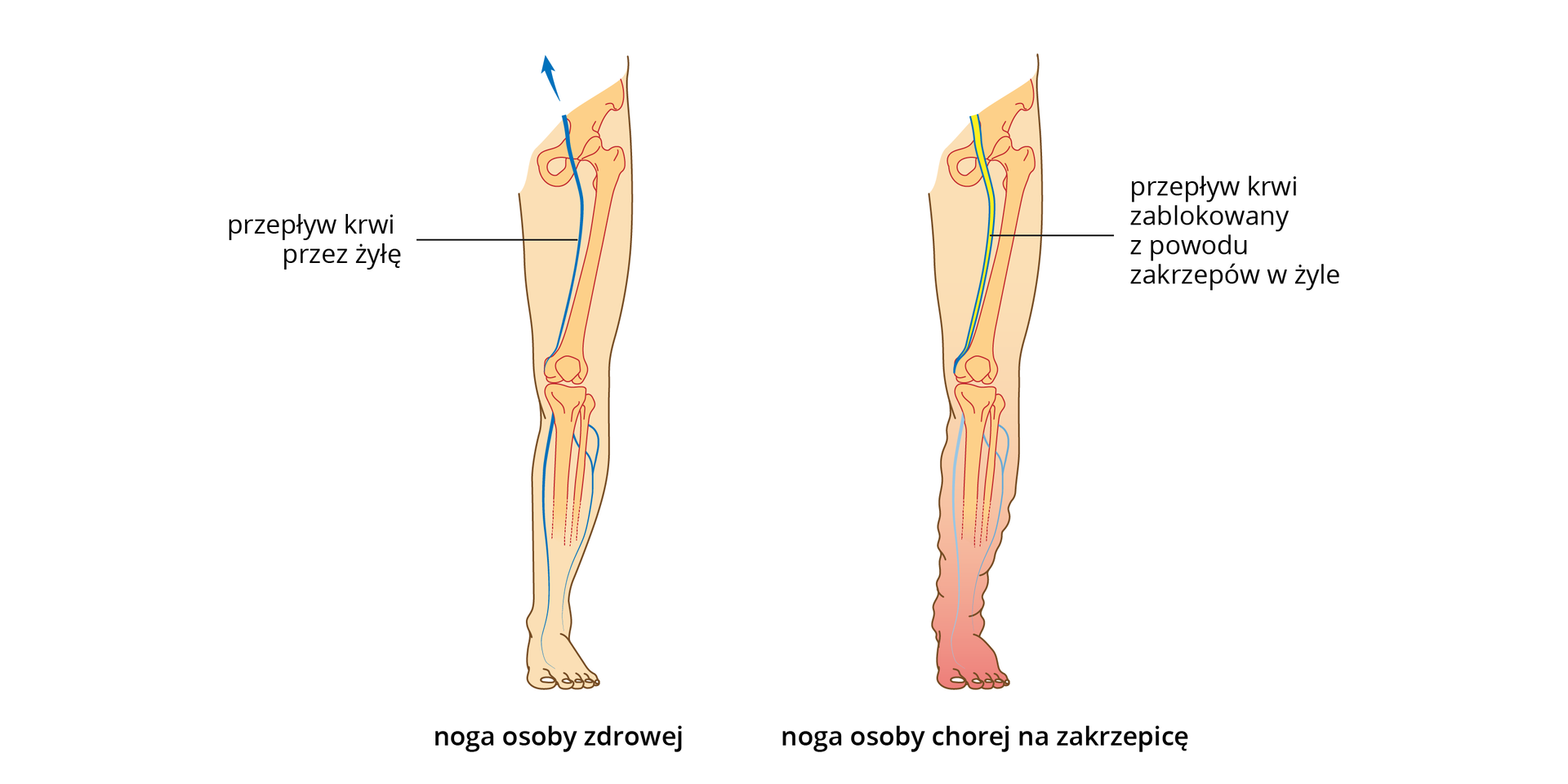Ilustracja przedstawia różowe sylwetki nóg człowieka, z wrysowanymi kośćmi i żyłami. Noga po lewej jest zdrowa. W nodze po prawej u góry żółtym kolorem ukazano zakrzepy, blokujące żyłę. Noga na dole jest zaczerwieniona i obrzęknięta.