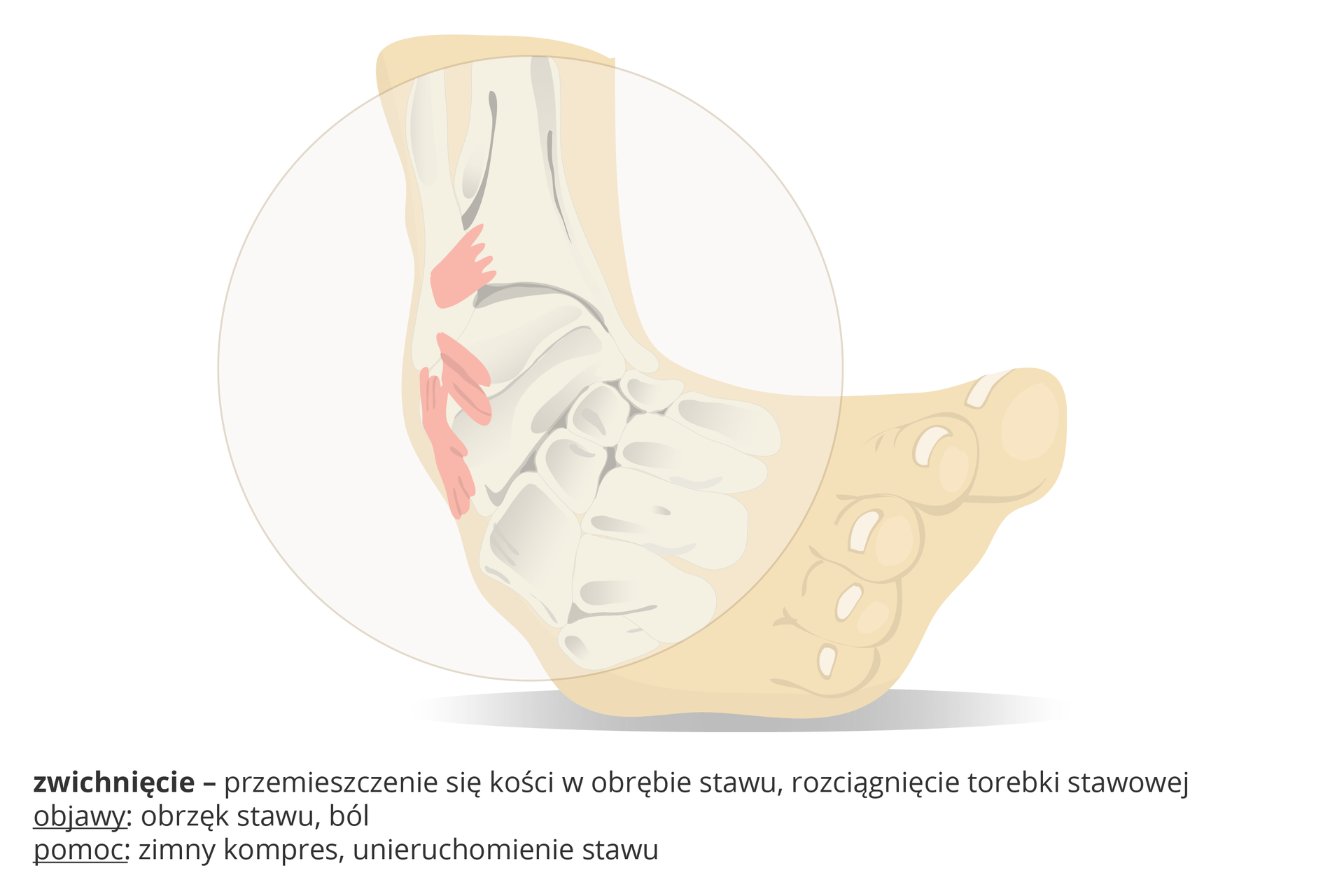 Ilustracja przedstawia schematycznie nienaturalnie wygiętą stopę, kółkiem zaznaczono obszar zwichnięcia, czyli przemieszczenia kości w stawie i naciągnięcia torebki stawowej. Objawy: obrzęk stawu, ból. Pomoc: zimny kompres, unieruchomienie stawu.