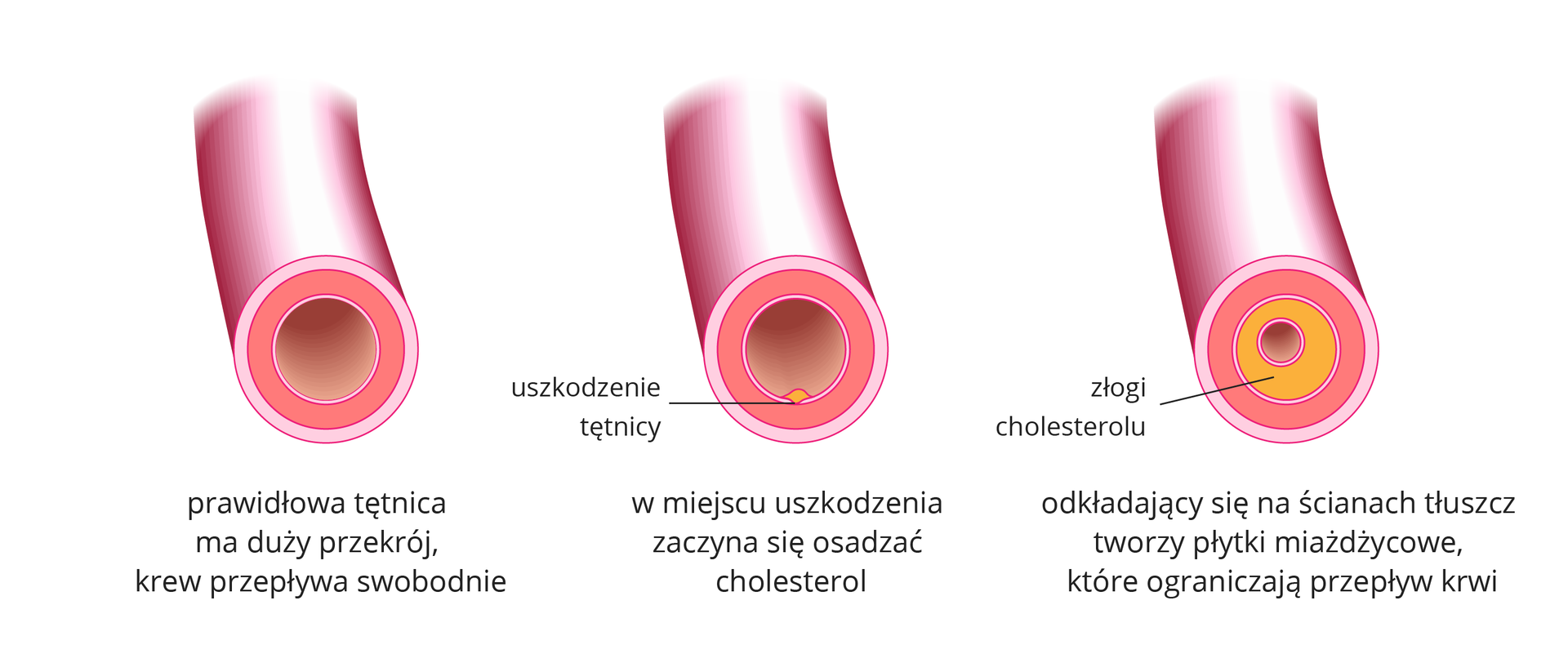 Ilustracja zawiera trzy rysunki przekrojów tętnic. Mają różowe ściany zewnętrzne, koralową warstwę mięśniową i beżową ścianę wewnętrzną. Lewa tętnica jest zdrowa. W środkowej wskazano miejsce uszkodzenia, w którym zaczyna się osadzać żółty cholesterol. Tętnica po prawej ma ścianę wewnętrzną zalepioną złogami cholesterolu i zwężone światło.
