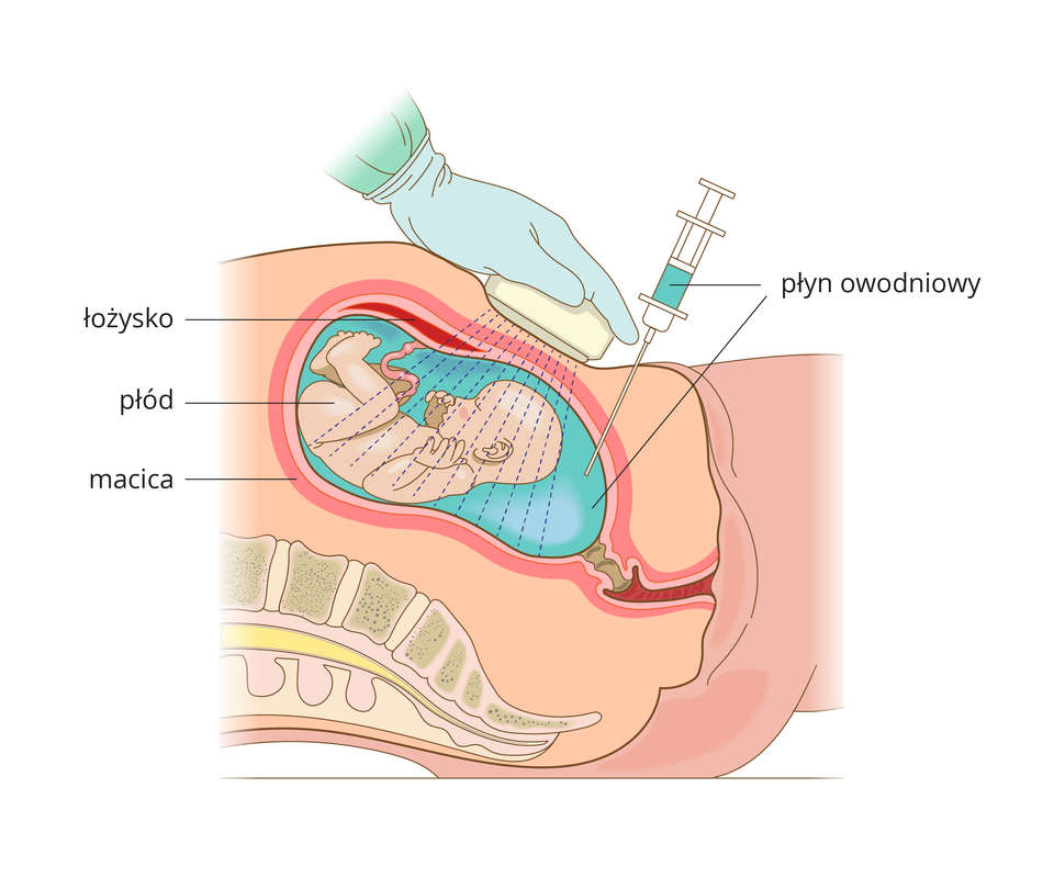 Ilustracja przedstawia pobieranie płynu owodniowego przez brzuszną powłokę ciała.