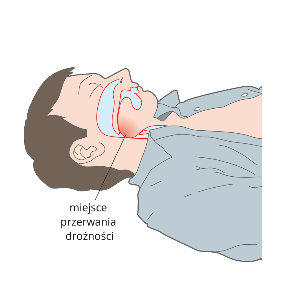 Ilustracja przedstawia poszkodowane nieprzytomnie starsze dziecko leżące na plecach. Koszula rozpięta. Zbliżenie na głowę dziecka. Prawa strona twarzy widoczna dla obserwatora. Na prawym boku twarzy błękitny schemat układu jamy nosowej i ustnej. Usta dziecka zamknięte. Język opada na tylną ścianę jamy gardłowej. Opis: miejsce przerwania drożności.