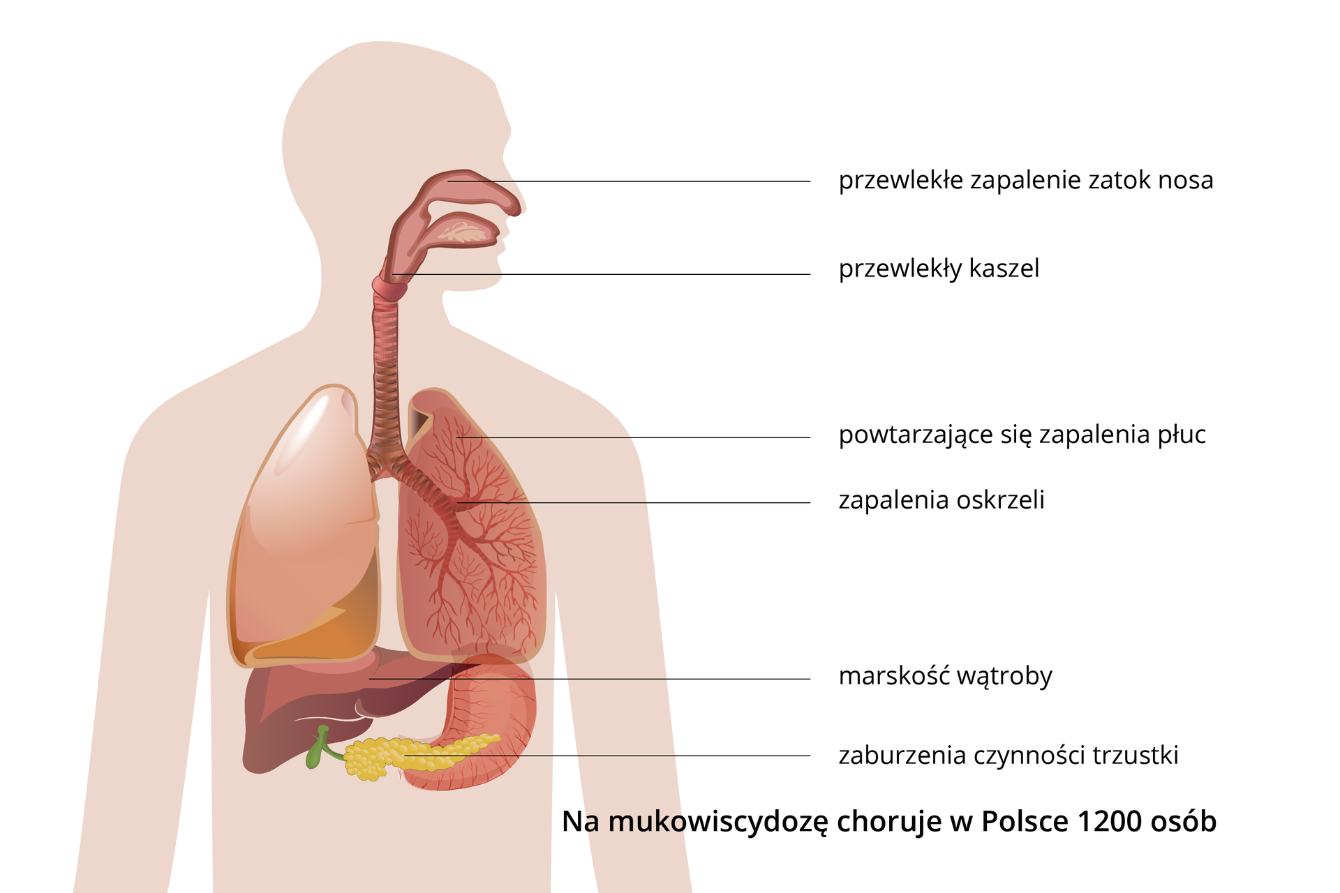 Ilustracja przedstawia liliową sylwetkę człowieka z wrysowanym układem oddechowym. Opisy z boku wskazują miejsca zachorowań i opisują objawy mukowiscydozy.