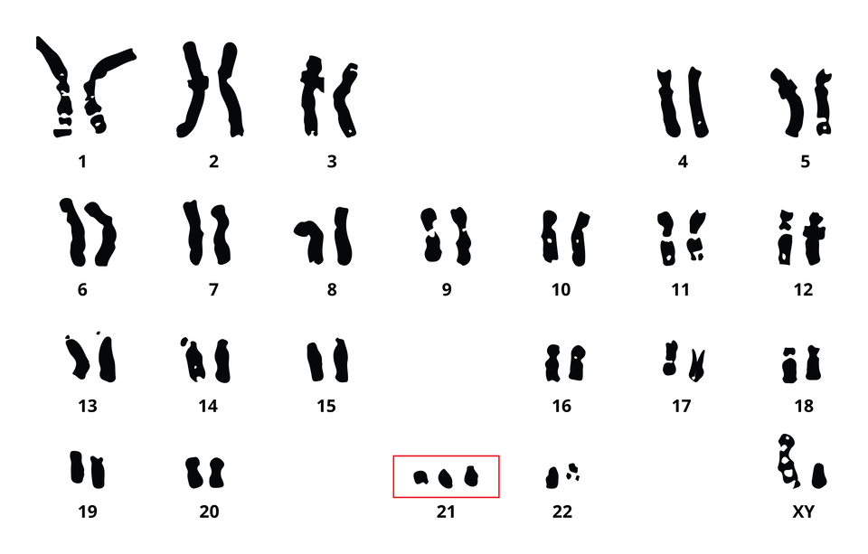 Ilustracja przedstawia zespół chromosomów osoby z zespołem Downa.Wszystkiei chromosomy tworzą pary, za wyjątkiem chromosomów 21, które jest 3. Jest to kariotyp mężczyzny, ostatnia para chromosomów to XY.