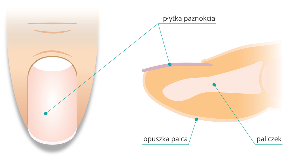 Ilustracja z lewej przedstawia w powiększeniu palec człowieka wraz z paznokciem widziany z góry. Z prawej przekrój poprzeczny przez czubek palca. W pomarańczowym wnętrzu opuszki palca zaznaczono szarą kość paliczka. U góry na opuszce liliowo zaznaczono płytkę paznokcia.