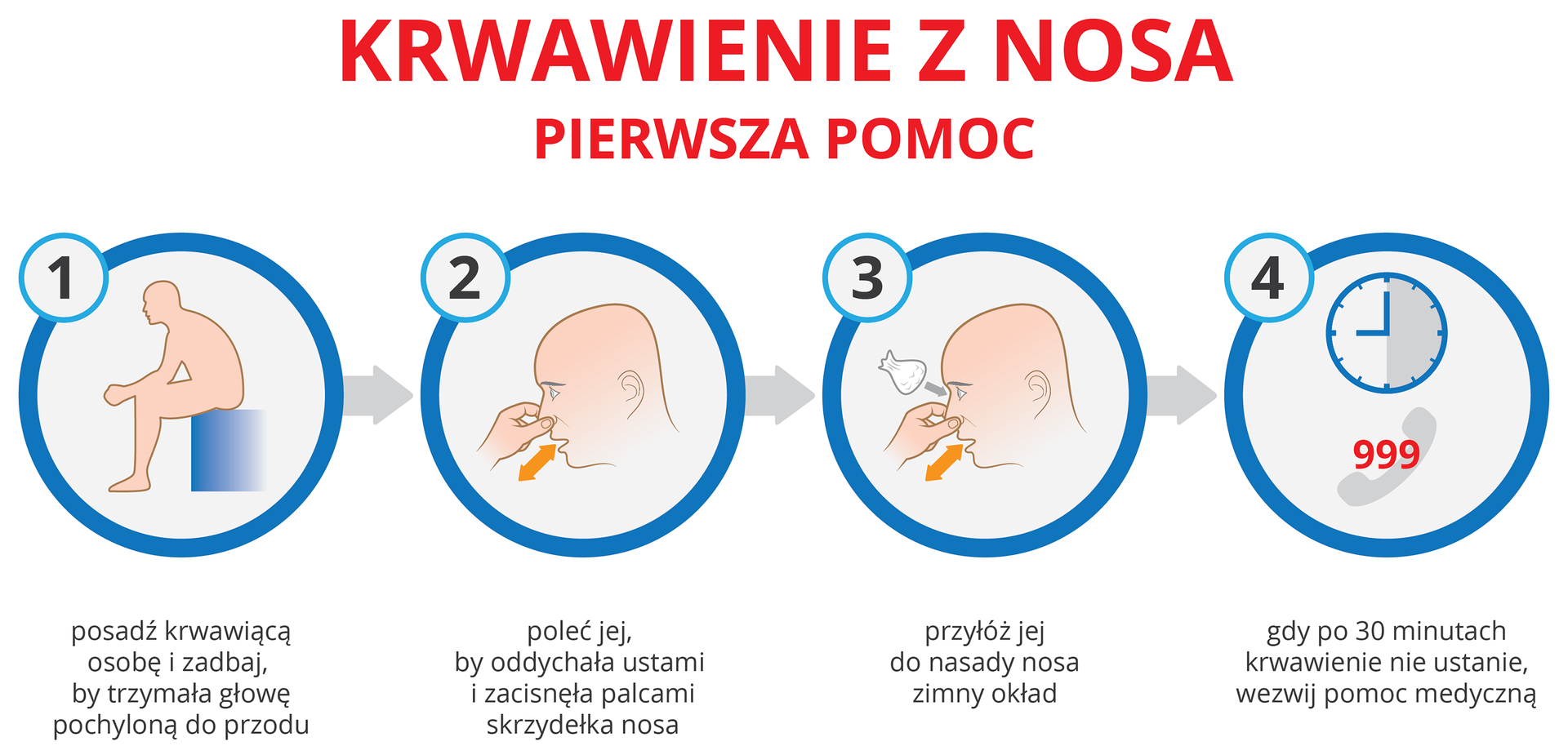 Ilustracja przedstawia cztery etapy pierwszej pomocy przy krwawieniu z nosa. Osoba krwawiąca przedstawiona w formie różowej sylwetki. Pierwszy etap polega na posadzeniu krwawiącej z nosa osoby głową w dół. Drugi krok to zaciśniecie skrzydełek nosa palcami i oddychanie przez usta (żółta strzałka). Na nasadę nosa należy przyłożyć zimny okład (tu: biały woreczek z lodem). Jeśli te sposoby nie przyniosą efektu i krwawienie nie ustaje po trzydziestu minutach, należy wezwać lekarza (symbol zegara, słuchawki i numer 999 – pogotowie ratunkowe).