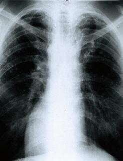 Zdjęcie rentgenowskie zmienionych przez gruźlcię płuc